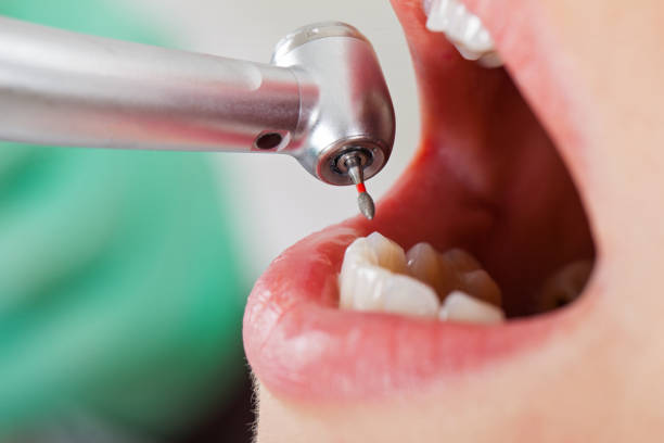 Best Emergency Dentist for Lost Fillings or Crowns in Brevard, NC